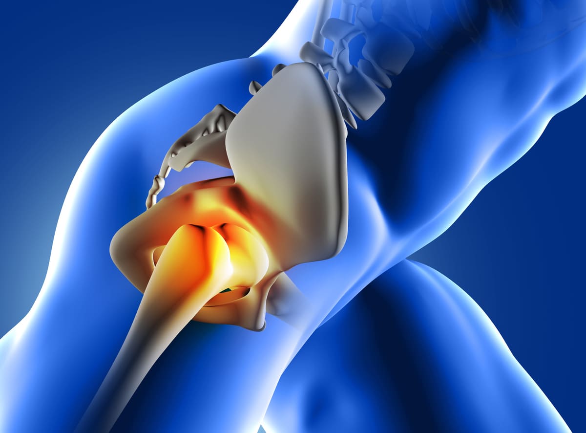 Cirugía de recambio protésico por coxartrosis
